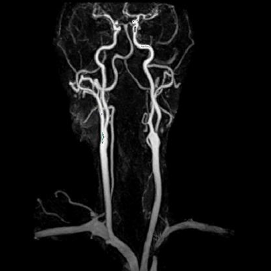 MR Angiography Neck With Contrast